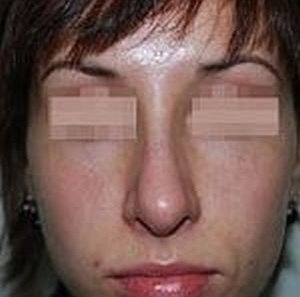 Исправление врожденной деформации наружного носа и искривленной носовой перегородки - До