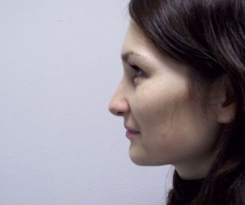 Коррекция формы носа и искревление носовой перегородки - После