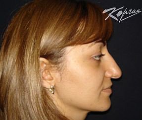 Полная коррекция носа: удаление горбинки, понижение спинки носа, исправление перегородки, корректировка кончика - До