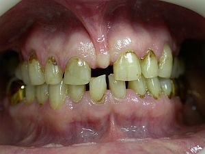 Эстетическая реставрация зубов - До