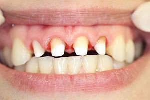 Реставрация зубов - До