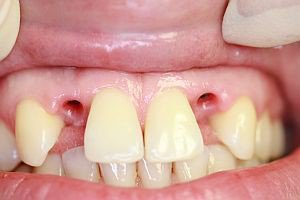 Эстетическая реставрация зубов - До