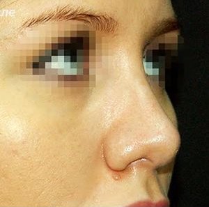 Ринопластика при проблемной коже носа - После