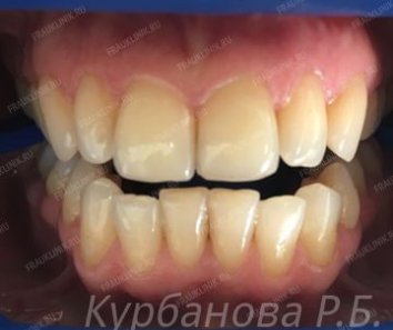 Отбеливание зубов - До