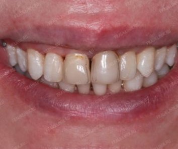 Восстановление эстетики зубов - До