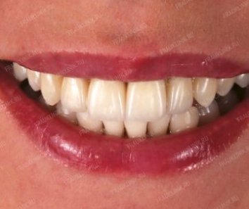 Восстановление эстетики зубов - После