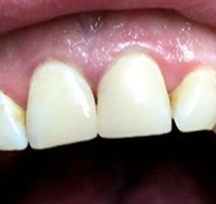 Восстановление передних зубов - До