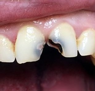 Восстановление передних зубов - После