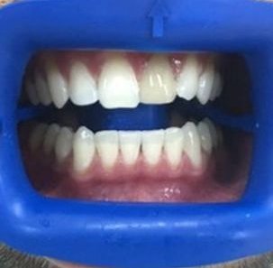 Отбеливание зубов по системе ZOOM4 - После