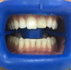 Отбеливание зубов по системе ZOOM4 - До