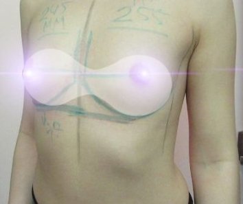 Увеличение груди после родов - До