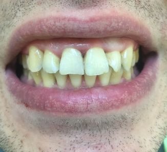 Реставрация передних зубов - После