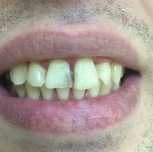 Реставрация передних зубов - До