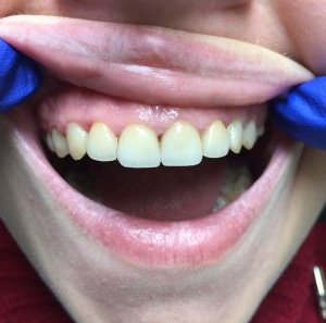 Керамические виниры E-MAX на передних зубах - После