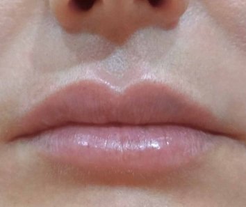  Коррекция формы губ - После