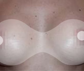 Увеличение груди, маммопластика - После