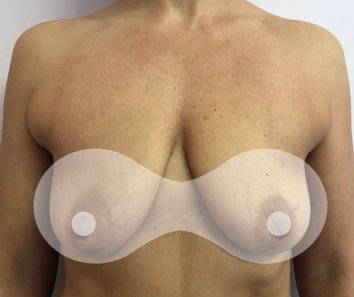 Подтяжка груди с увеличением - До