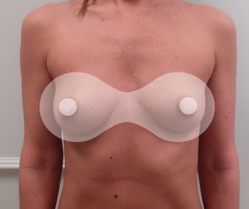 Увеличение груди без подтяжки - До