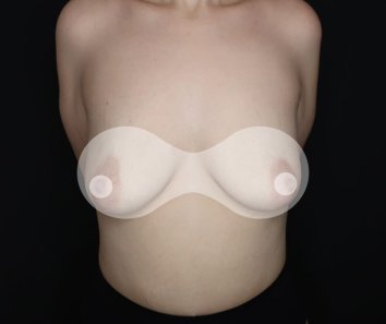 Увеличение груди с подтяжкой - До